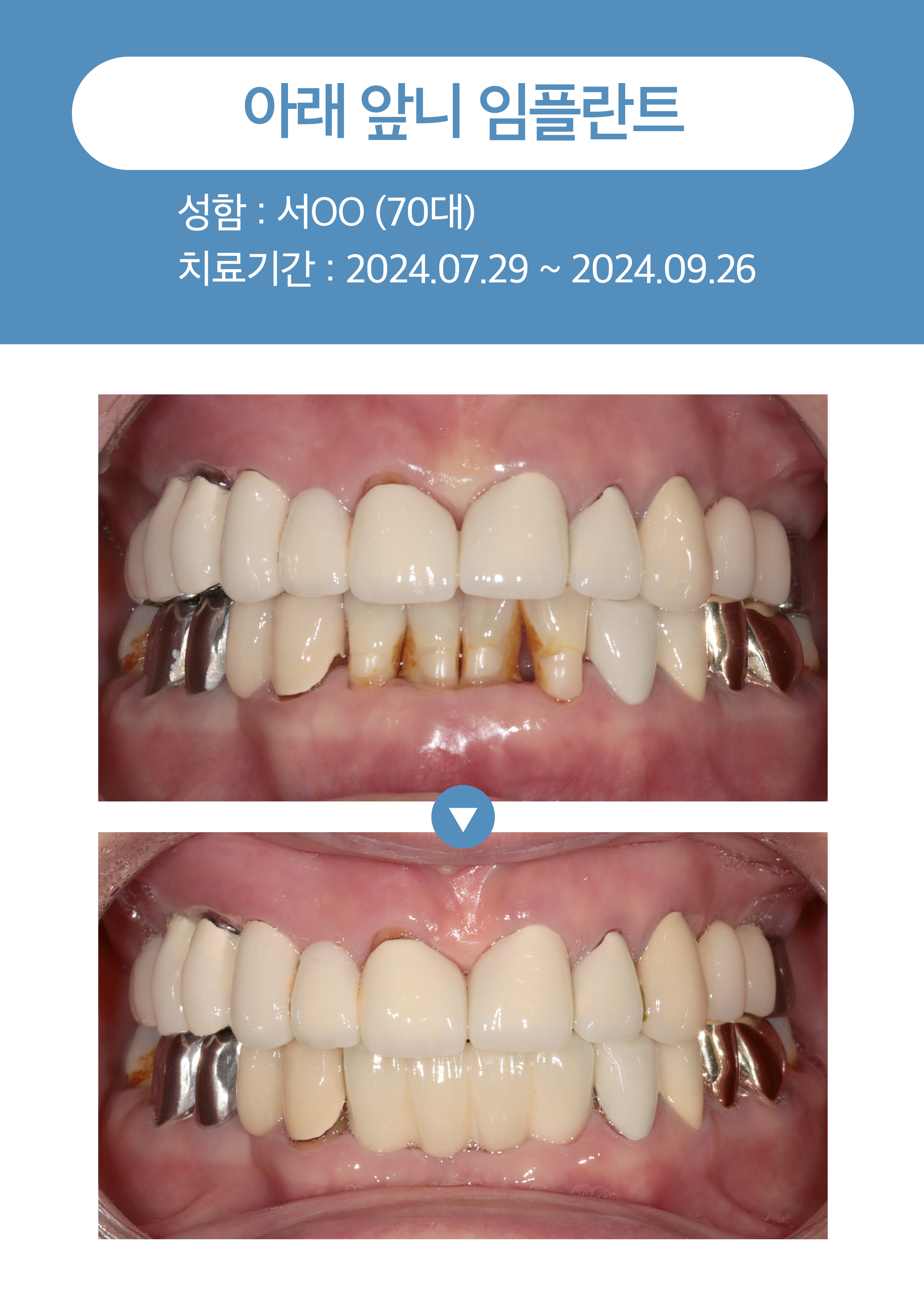 앞니 아래 임플란트