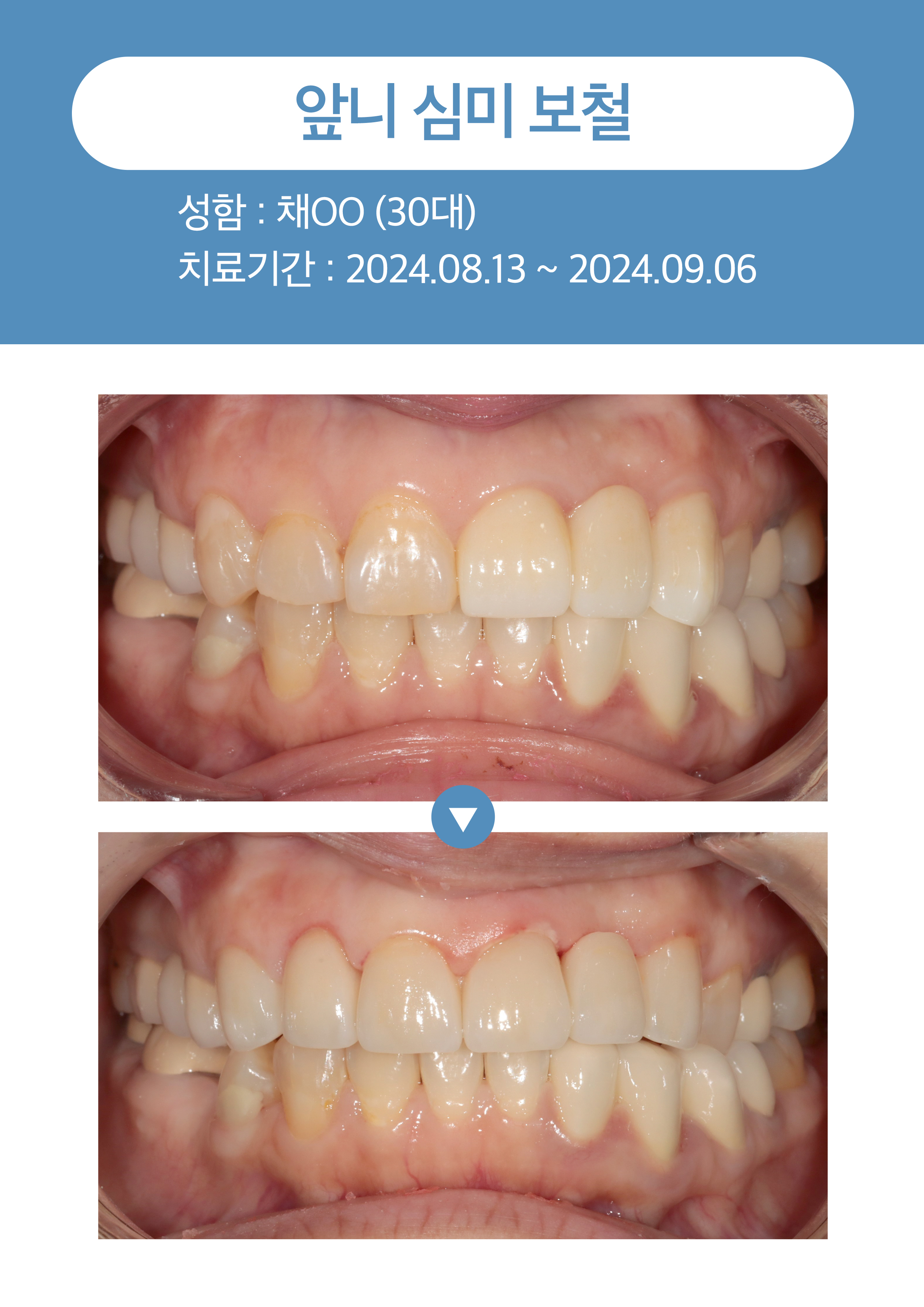 앞니 심미보철1