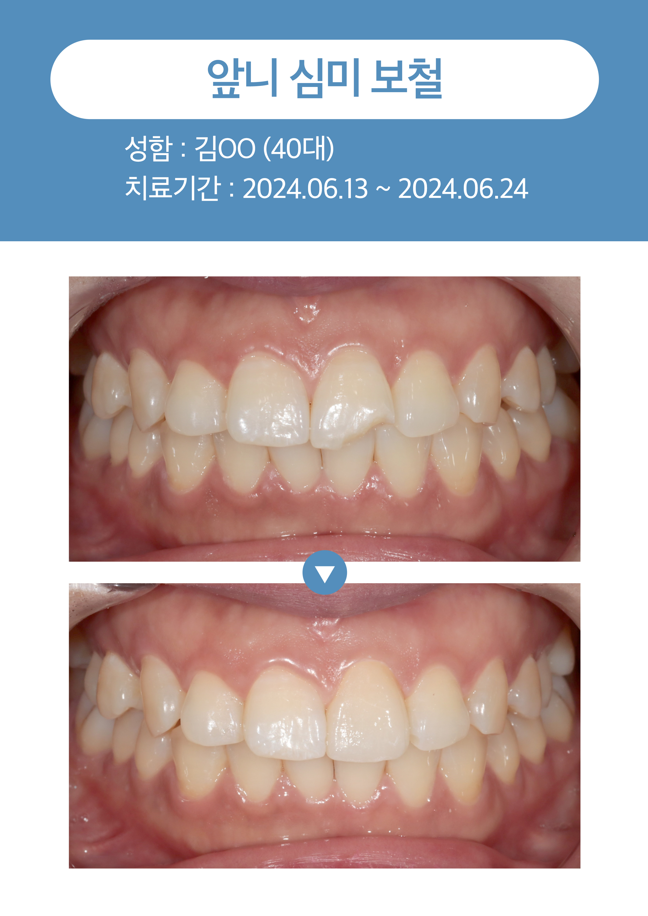 앞니 심미보철2